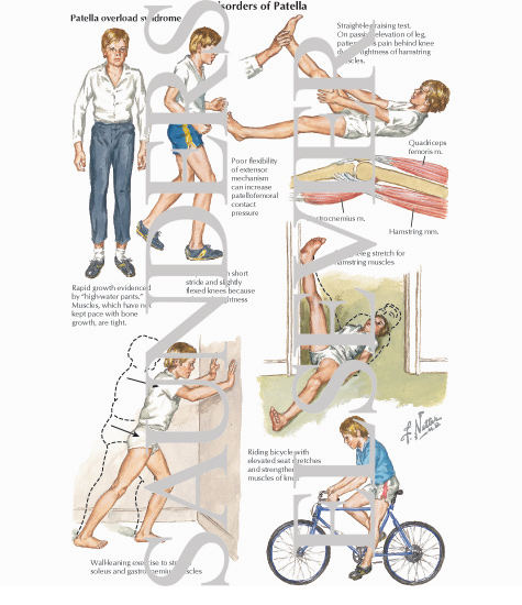Disorders of Patella