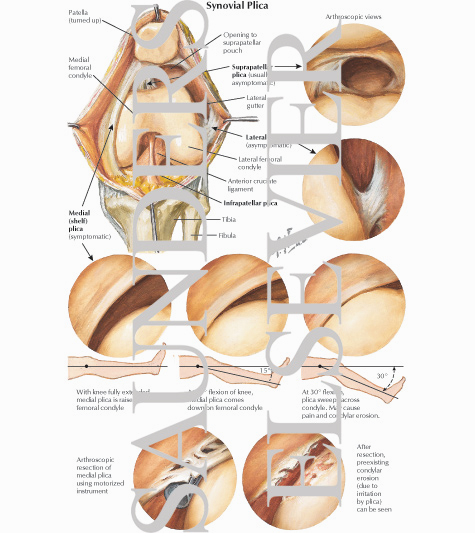Synovial Plica