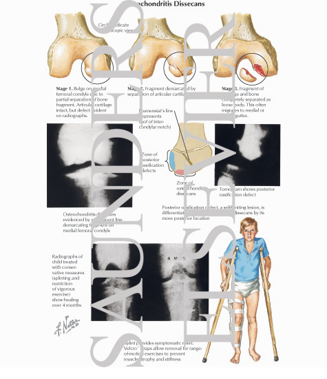 Osteochondritis Dissecans
