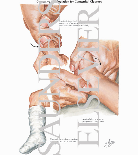 Corrective Manipulation for Congenital Clubfoot