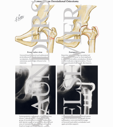 Osteotomy Femur