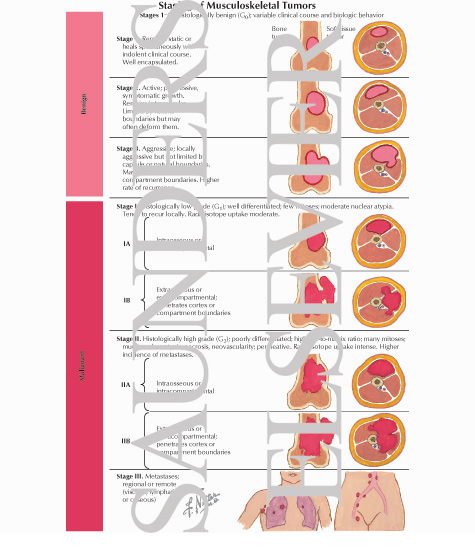 Staging of Musculoskeletal Tumors