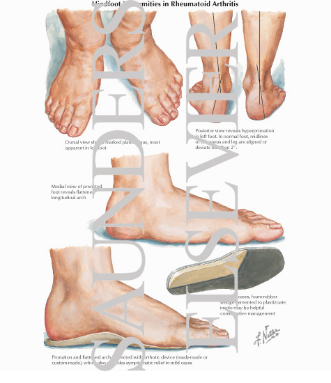 Hindfoot Deformities in Rheumatoid Arthritis