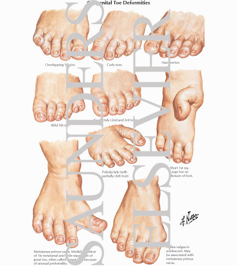Congenital Toe Deformities