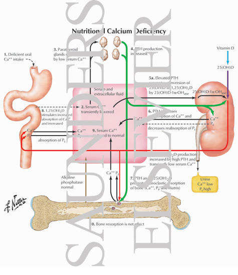 deficiency of calcium. Nutritional Calcium Deficiency