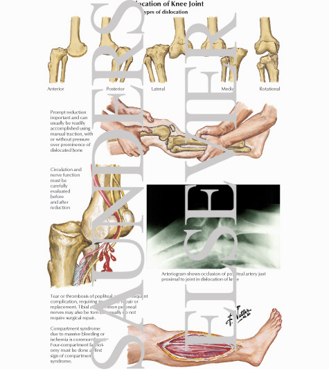 Dislocation of Knee Joint The preview images do not contain enough pixels to 