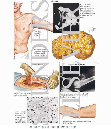 Lipoma, Neurofibroma, Myositis Ossificans The preview images do not contain 