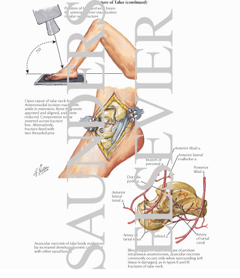 Arteries of the Foot and Ankle
Fracture of Talus