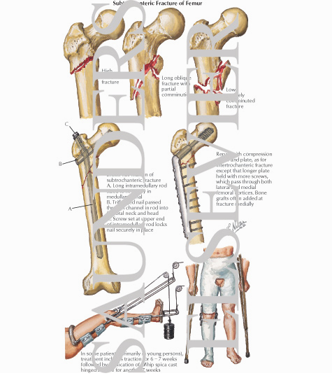 Subtrochanteric Fracture of Femur