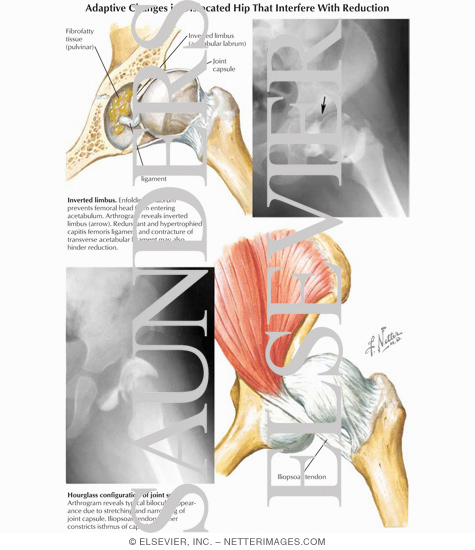 Adaptive Changes in Dislocated Hip Interfering with Reduction
