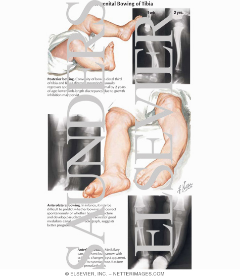 Congenital Bowing of Tibia