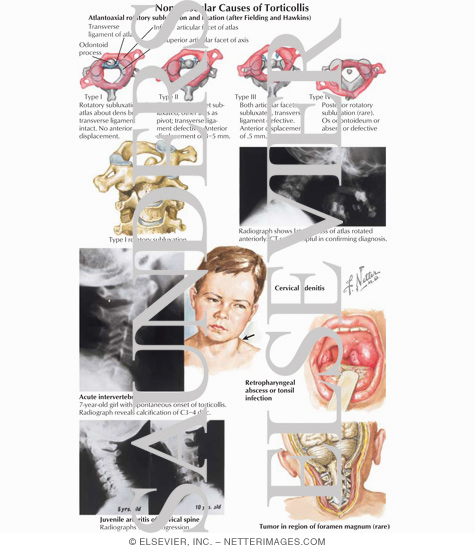 Nonmuscular Causes of Torticollis