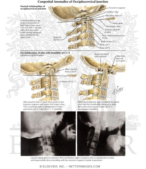 Congenital Anomalies of Occipitocervical Junction