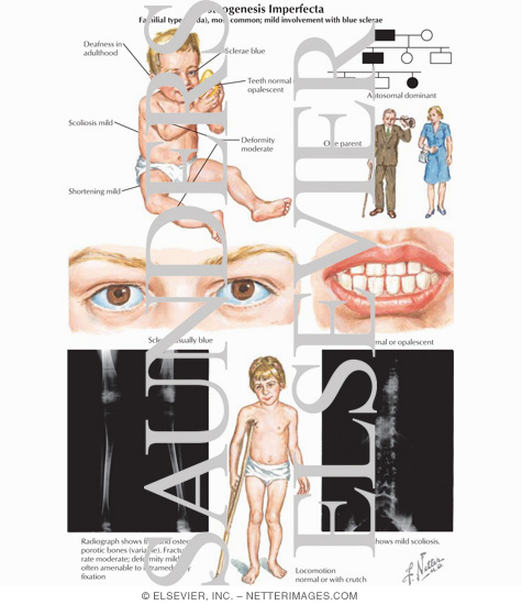 osteogenesis imperfecta osteogenesis imperfecta