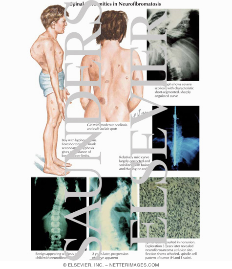 Spinal Deformities in Neurofibromatosis