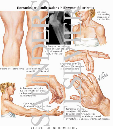 Extraarticular Manifestations In Rheumatoid Arthritis