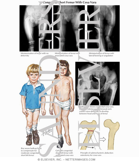 congenital coxa vara