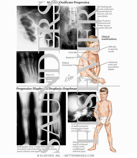 Myositis Ossificans Progressiva, Progressive Diaphyseal Dysplasia (Engelmann's Disease)