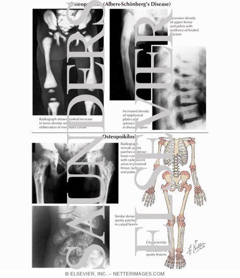 Osteopetrosis (Albers - Schonberg's Disease), Osteopoikilosis
