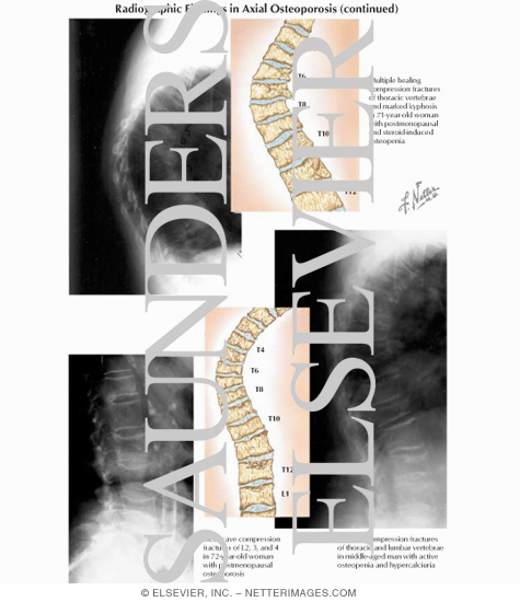 Radiographic Findings In Axial Osteoporosis
