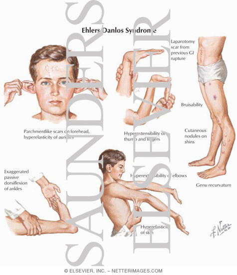 Misinterpretation of Child Injuries:Ehler's Danlos Syndrome False Child Abuse Charge