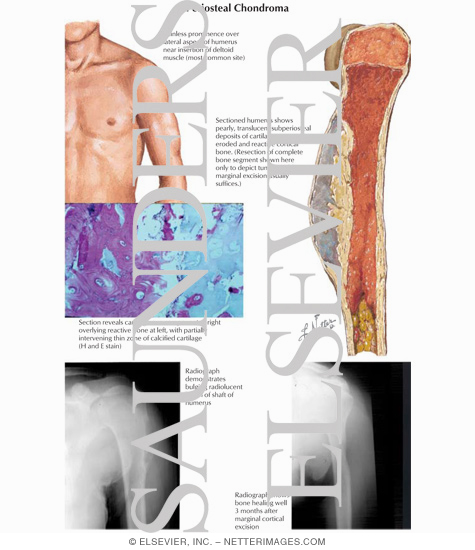 Periosteal Chondroma