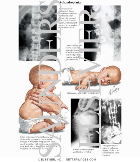 Achondroplasia
