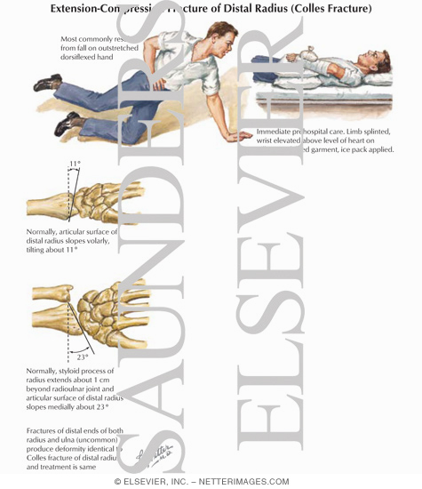 Extension / Compression Fracture of Distal Radius (Colles Fracture)