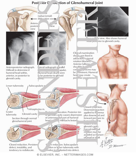 Posterior Dislocation of