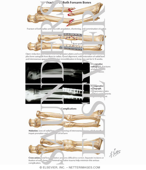 Fracture of Both Forearm Bones