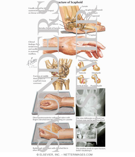 Fracture of Scaphoid