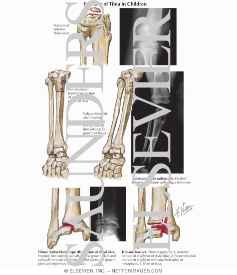 Fracture of Tibia in Children