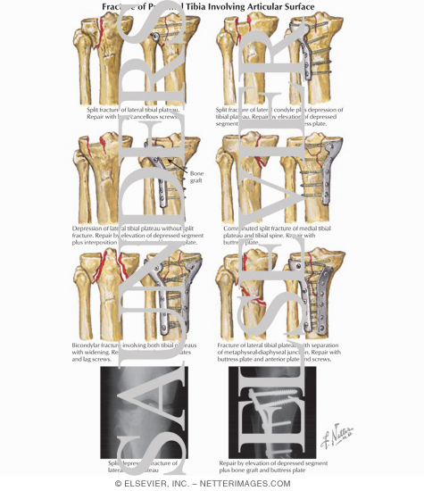 Fracture of Proximal Tibia Involving Articular Surface