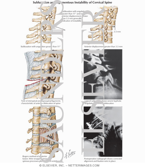 Subluxation and Ligamentous Instability of Cervical Spine
Trauma