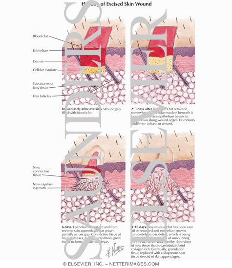 Wound Skin