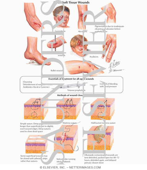 Open Soft Tissue Wounds