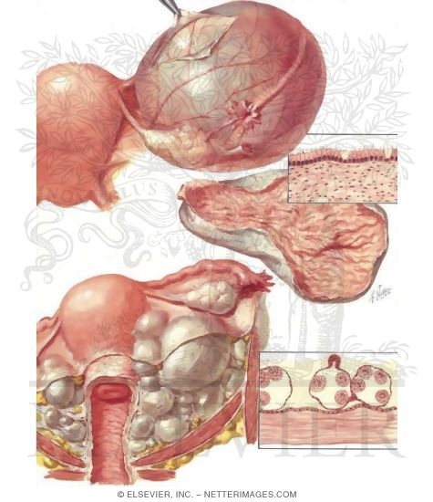 Paraovarian Or Epoophoron Cyst