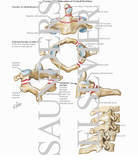 Fracture and Dislocation of Cervical Vertebrae
Trauma