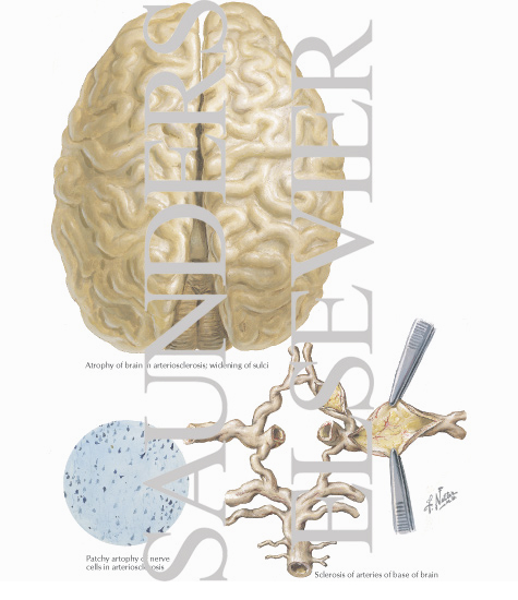 Cerebral Arteriosclerosis