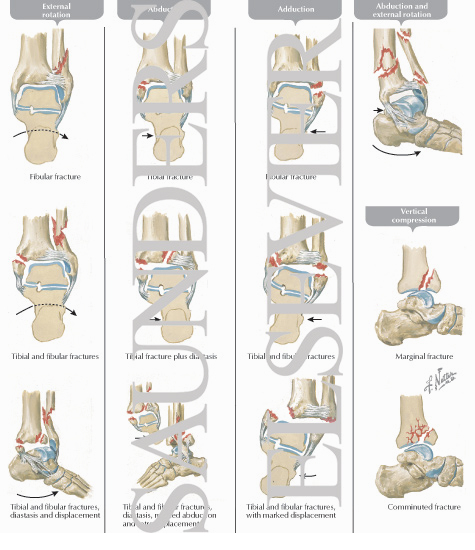 Fractures and Fracturing Forces