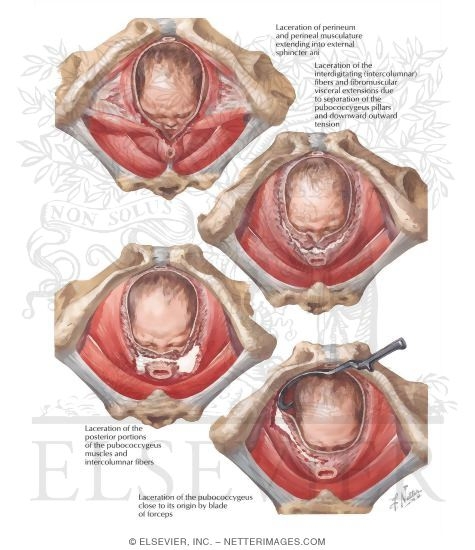 Episiotomy