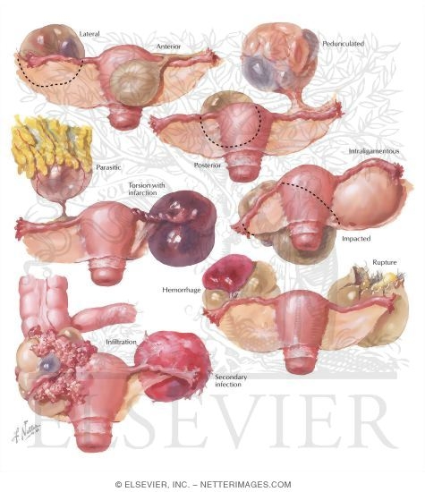 Diagnosis of Ovarian Neoplasms