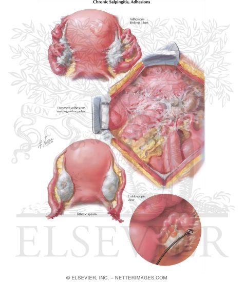 Chronic Salpingitis, Adhesions, Differential Diagnosis