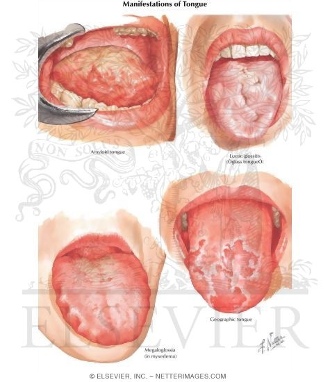 Manifestations of Tongue