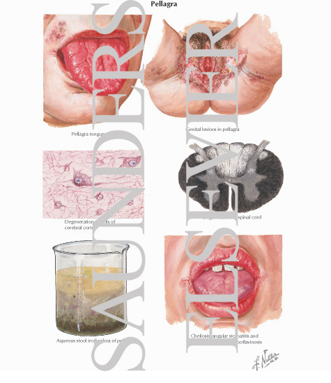 Pellagra