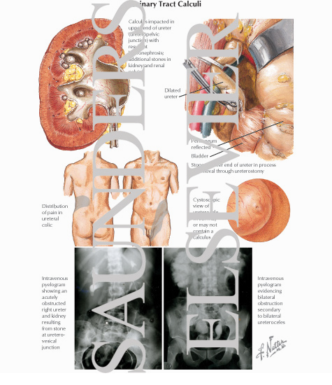 Urinary Tract Calculi