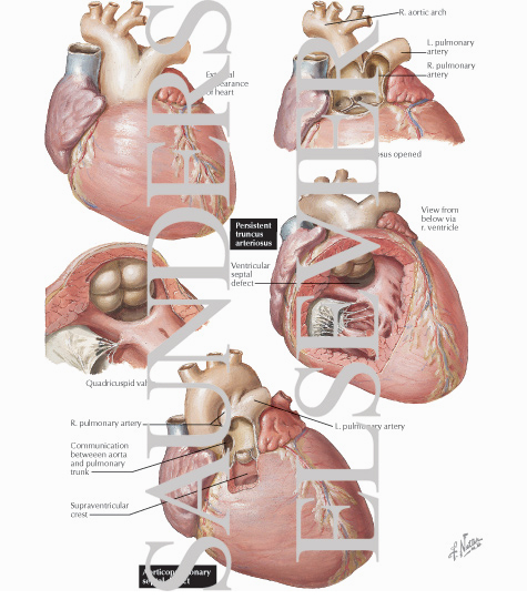 Anomalies of the Truncus Septum - Persistent Truncus Arteriosus