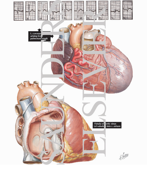 Anomalous Left Coronary Artery and Aneurysm of the Sinus of Valsalva
