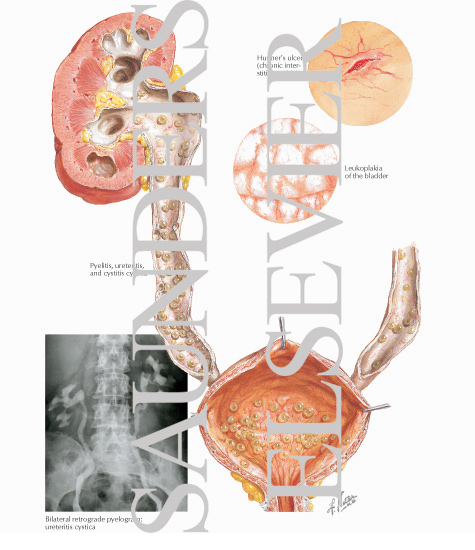 Cystitis