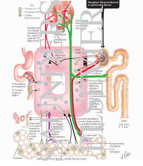 Secondary (Renal) Hyperparathyroidism (Renal Osteodystrophy)